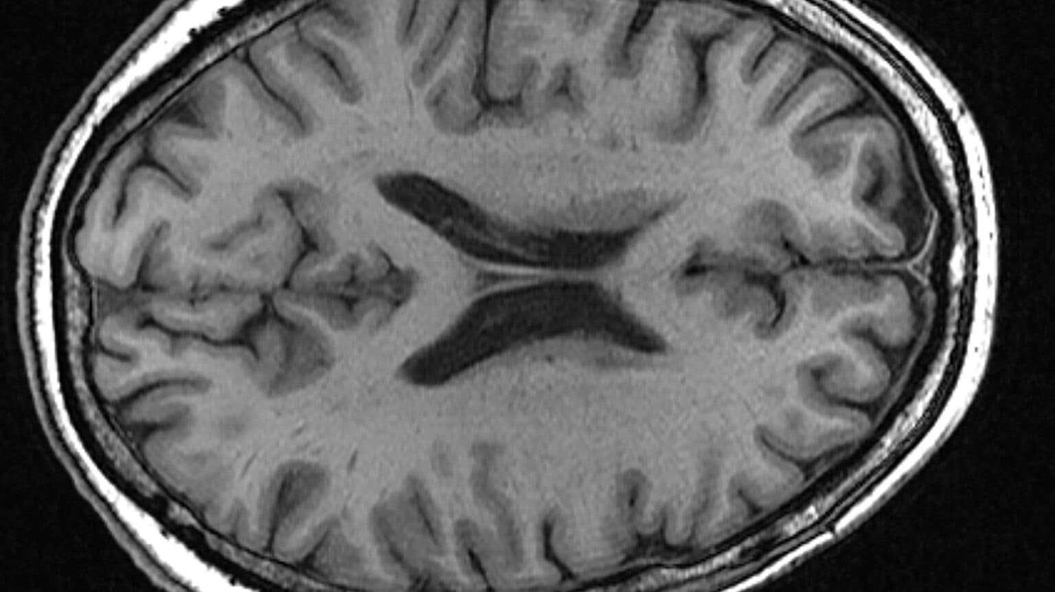 Parkinson's